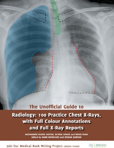 The Unofficial Guide to Radiology 100 Practice Chest X Rays with Full Colour Annotations and Full X Ray Reports.