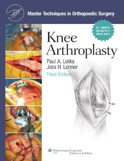 Master Techniques in Orthopaedic Surgery, Knee Arthroplasty.