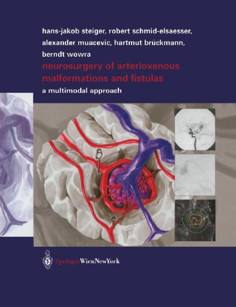 Neurosurgery of Arteriovenous Malformations and Fistulas A Multimodal Approach.